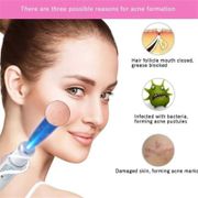 Therapy Treatment Pen Laser Removal Light Wrinkle Devices Soft Blue Scar Acne